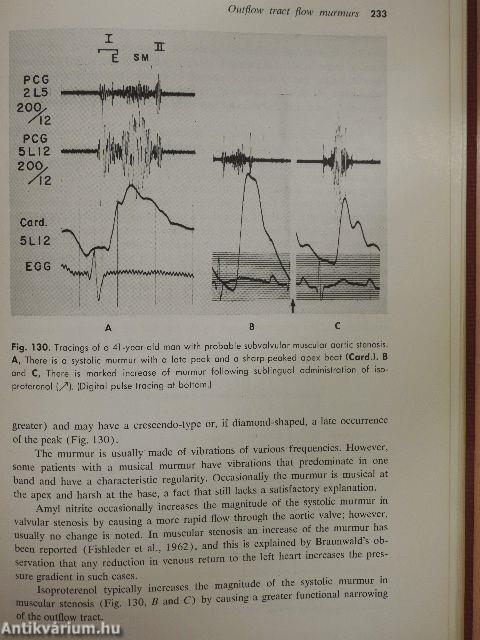 From auscultation to phonocardiography