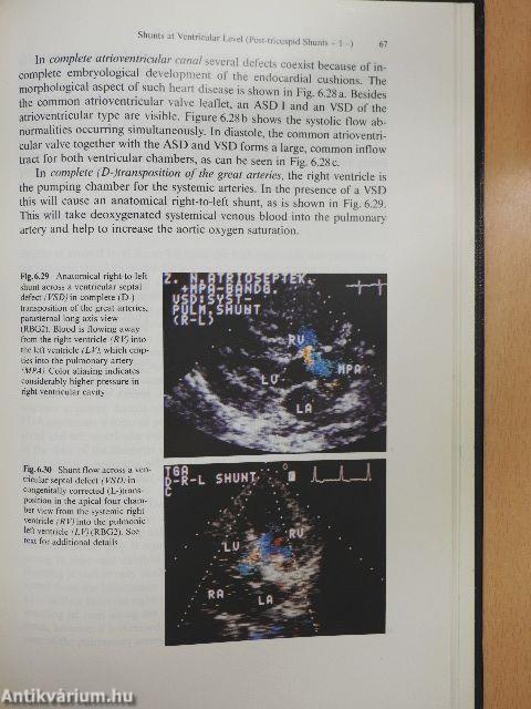 Color Blood Flow Imaging of the Hearth