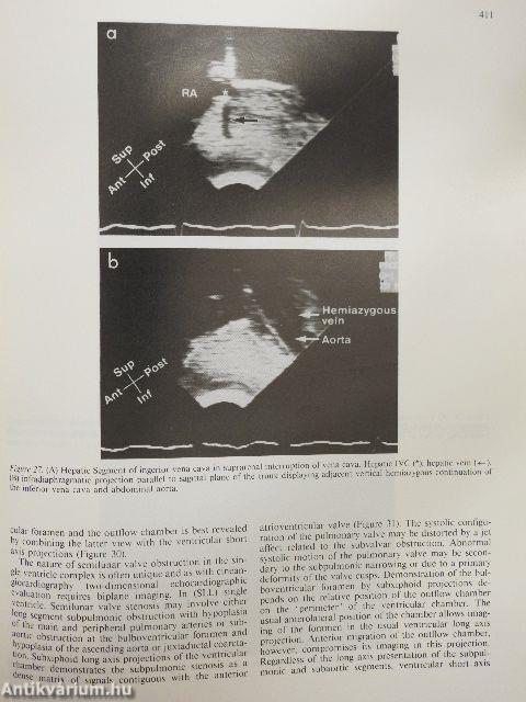 Two-dimensional real-time ultrasonic imaging of the heart