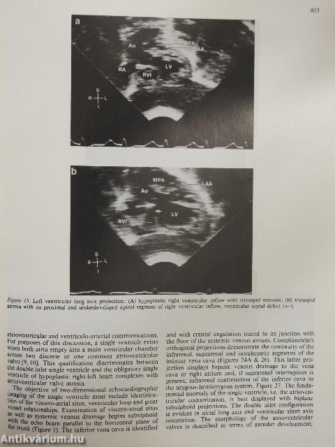 Two-dimensional real-time ultrasonic imaging of the heart