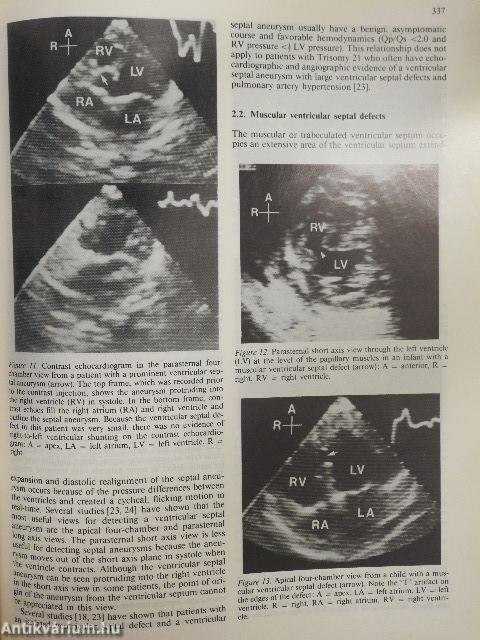 Two-dimensional real-time ultrasonic imaging of the heart