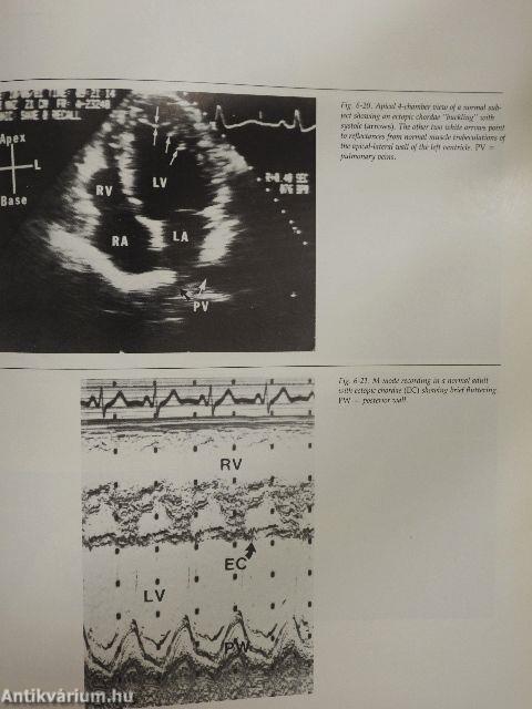 Two-dimensional echocardiography