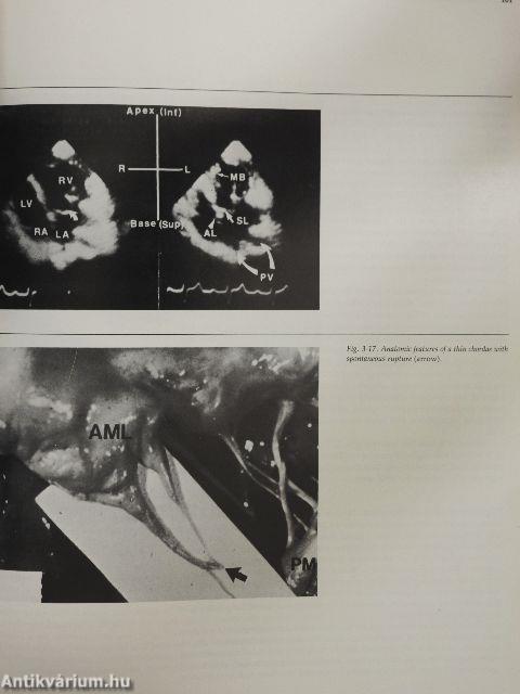 Two-dimensional echocardiography