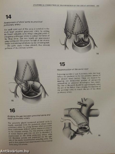 Cardiothoracic surgery