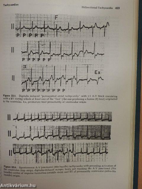 Cardiac Arrhythmias