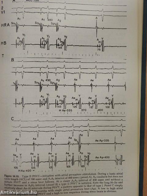 Cardiac Arrhythmias