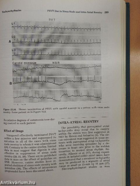 Cardiac Arrhythmias