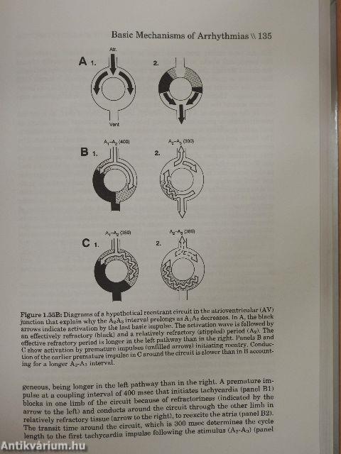 The Ventricular Arrhythmias of Ischemia and Infarction