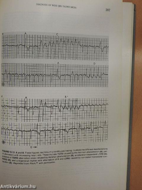 Cardiac Electrophysiology and Arrhythmias