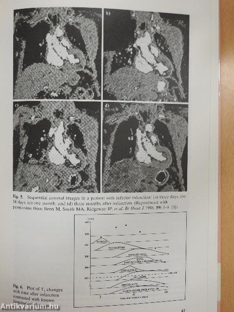 The Management of Acute Myocardial Ischaemia