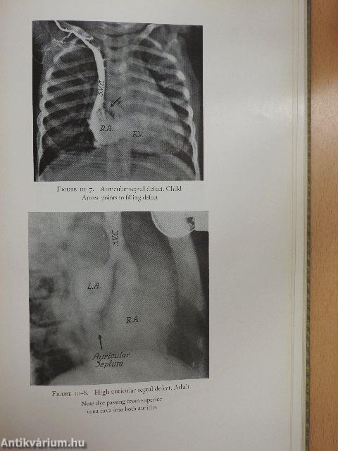 Congenital Malformations of the Heart I.