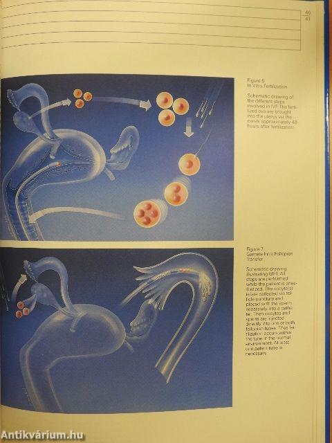 Endometriosis