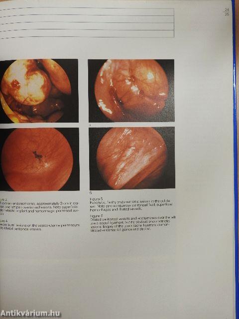 Endometriosis