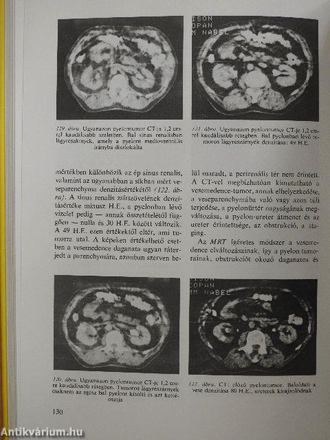 Az urológiai rosszindulatú daganatok