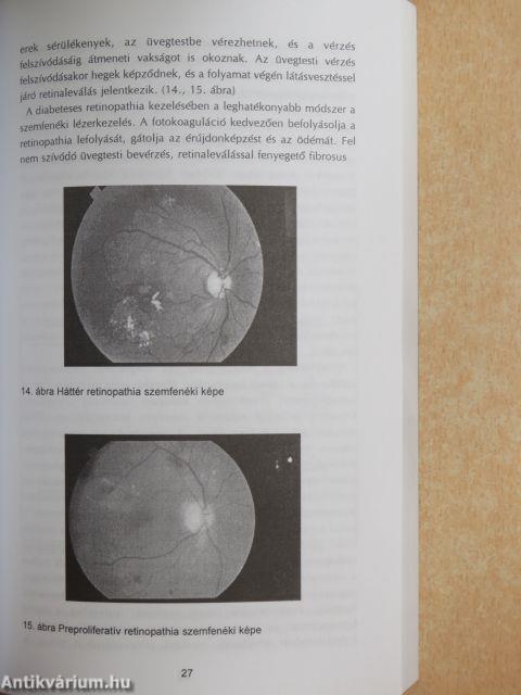 Hypertonia és nephropathia diabetesben