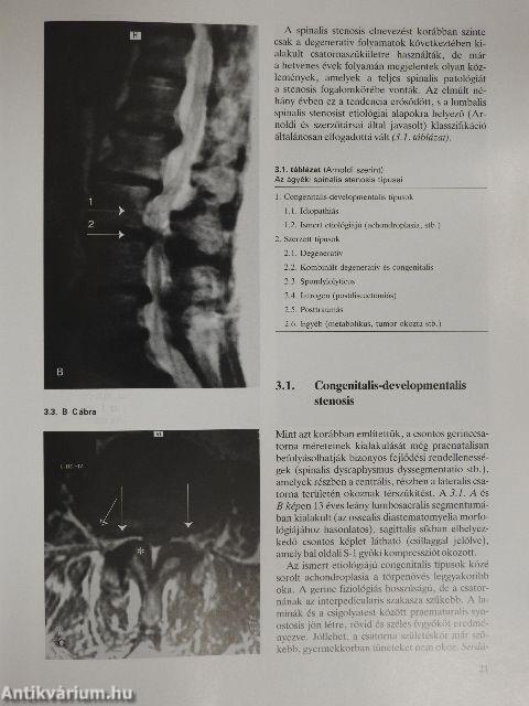 Lumbalis spinalis stenosis