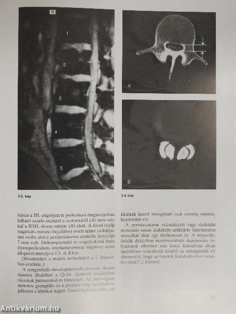 Lumbalis spinalis stenosis