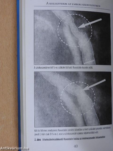 A koleszterintől a szívinfarktusig