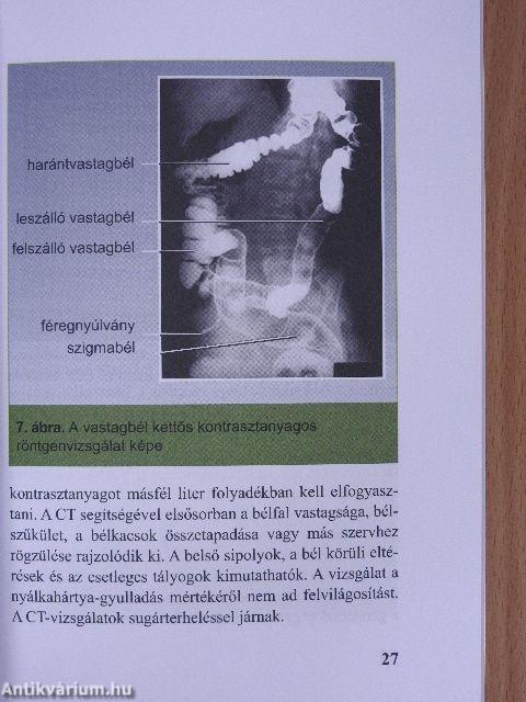 Gyulladásos bélbetegségek