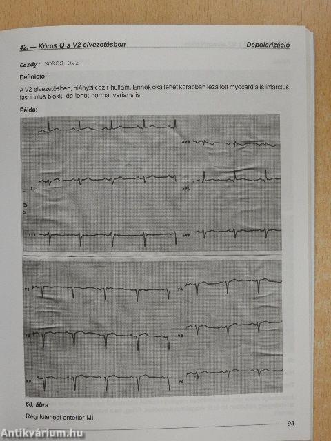 EKG súgó