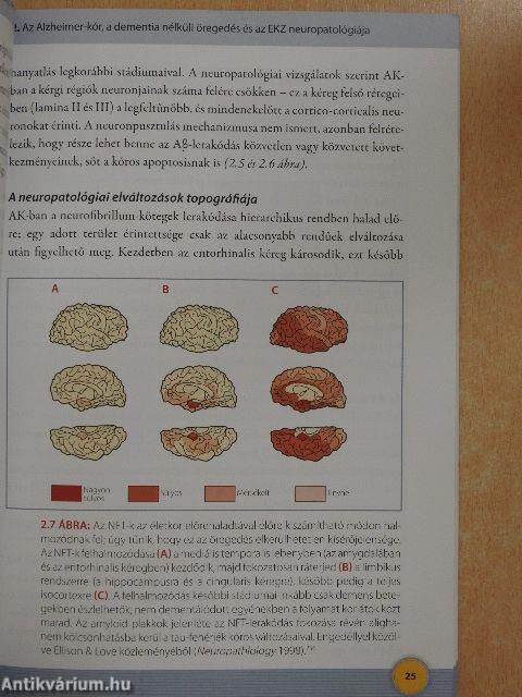 Enyhe kognitív zavar és az Alzheimer-kór korai formái