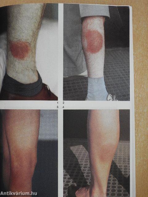 A lyme borreliosis