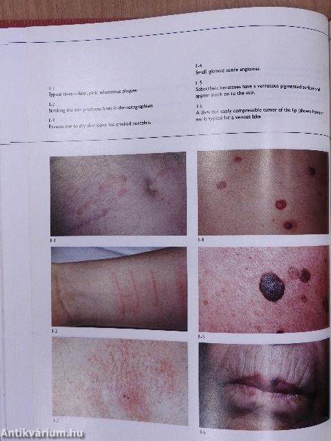 The Nurse's Atlas of Dermatology