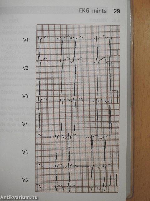 Elektrokardiográfia - 60 esetismertetés