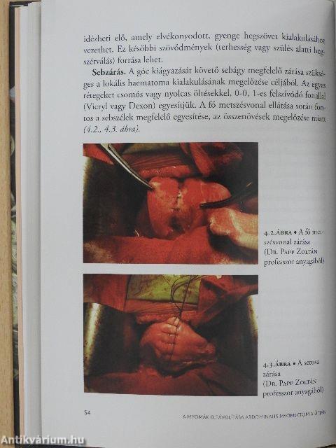 A myoma korszerű kezelése