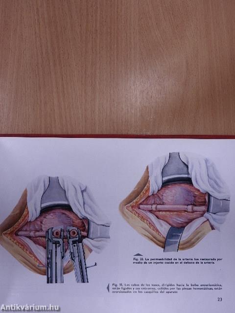 Atlas de Intervenciones Quirurgicas con el Empleo de Aparatos de Sutura Mecanica