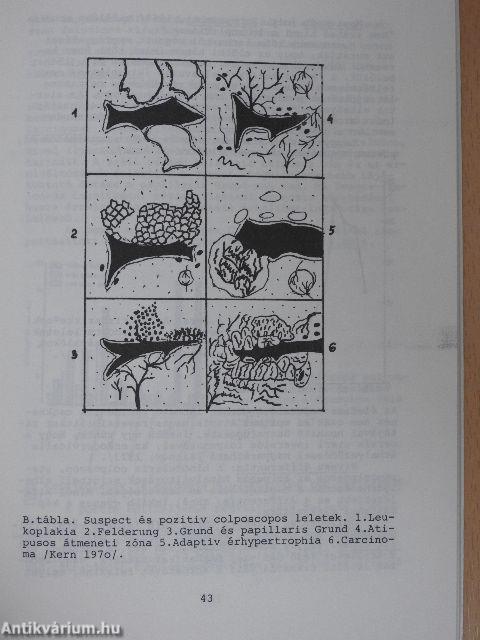 Rákszűrés - A genitalis carcinoma korai felismerése 1974/5