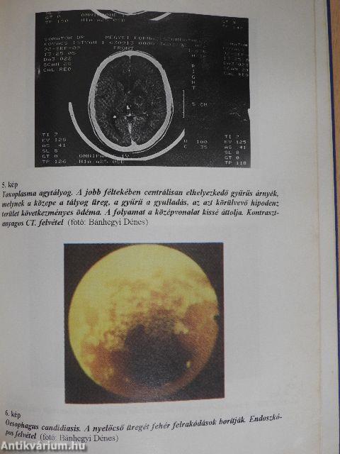 AIDS - tények és előrejelzések a legújabb kutatások tükrében