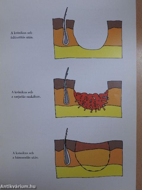 Sebek és a sebgyógyulás