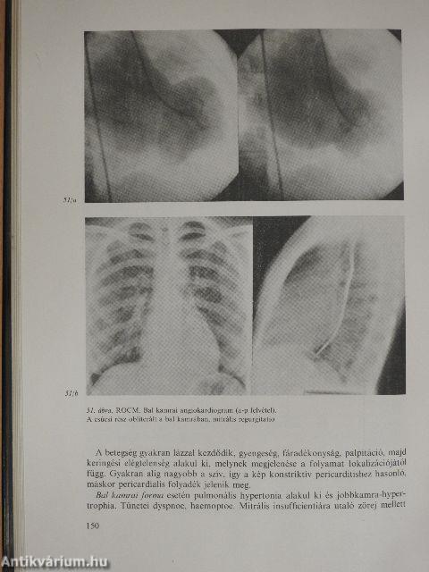 Cardiomyopathia