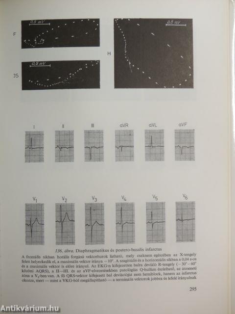 Myocardialis infarctus