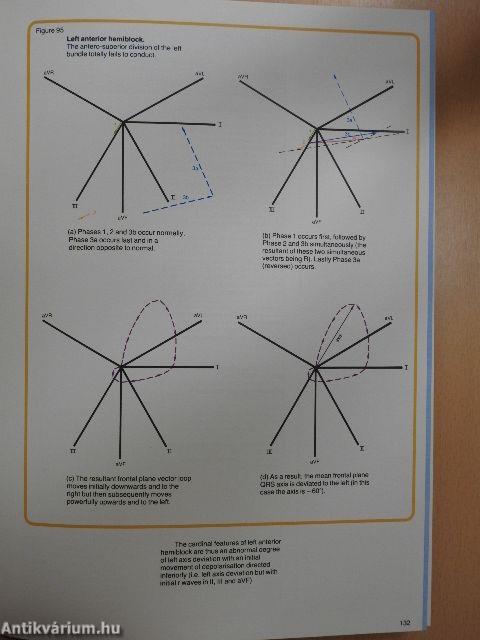 Understanding the Electrocardiogram 2.