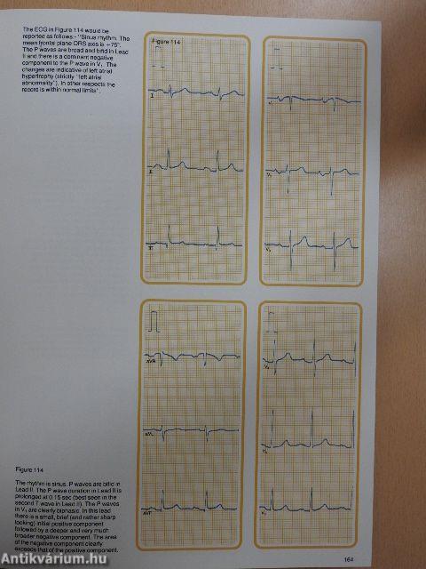 Understanding the Electrocardiogram 2.