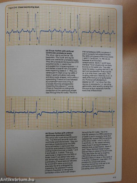 Understanding the Electrocardiogram 3