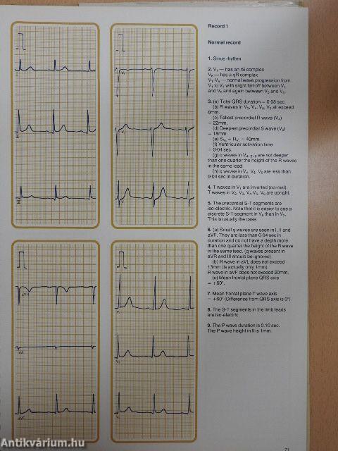 Understanding the Electrocardiogram 1.