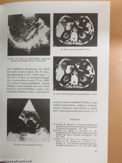 Az urológiai rosszindulatú daganatok