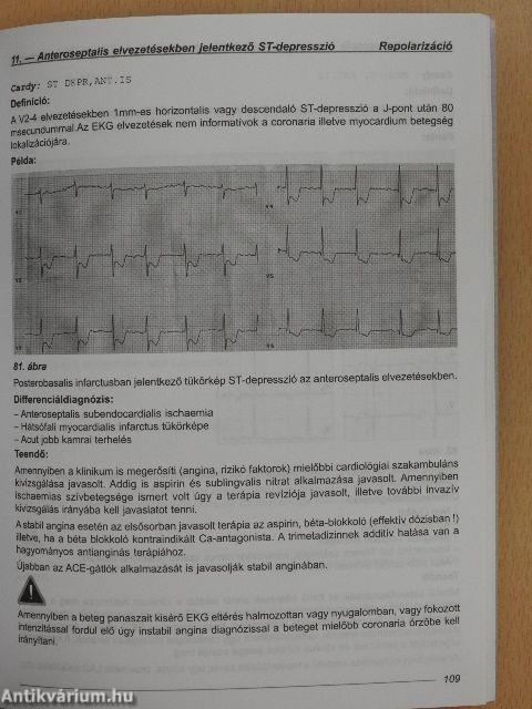 EKG súgó