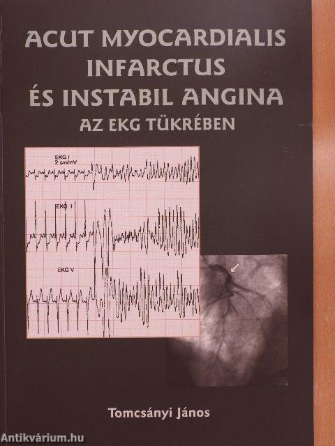 Acut myocardialis infarctus és instabil angina az EKG tükrében