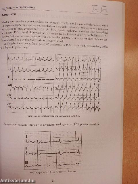 Acut myocardialis infarctus és instabil angina az EKG tükrében