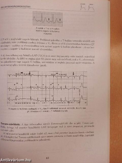 Acut myocardialis infarctus és instabil angina az EKG tükrében