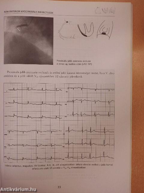 Acut myocardialis infarctus és instabil angina az EKG tükrében