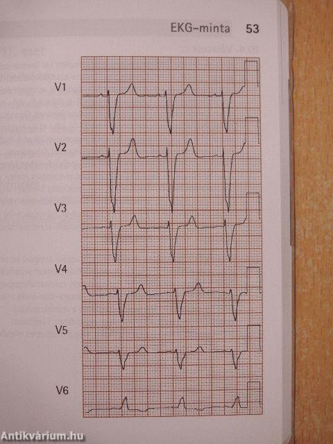 Elektrokardiográfia - 60 esetismertetés
