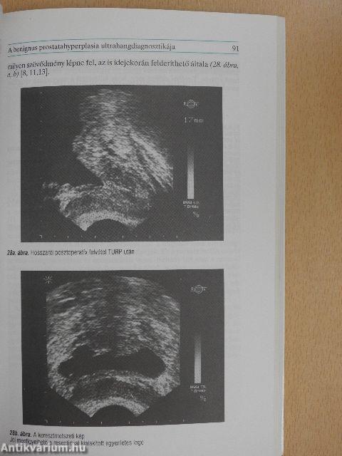 Benignus prostatahyperplasia