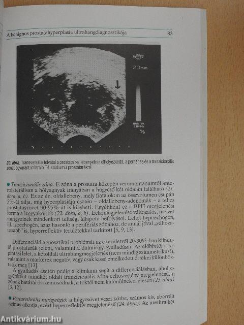 Benignus prostatahyperplasia