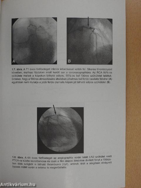 A coronaria angiographia és angioplastica kézikönyve