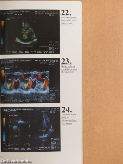 A színkódolt doppler echocardiographia atlasza